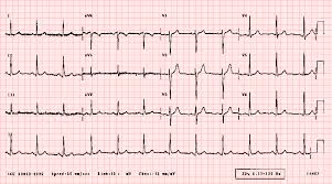 ECG